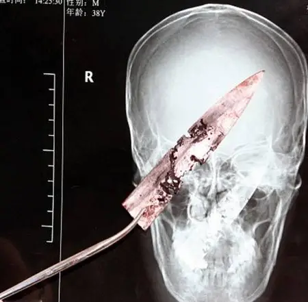 Man who’d suffered from headaches discovered he had rusty knife in head for four years